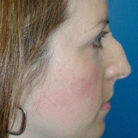 B&A - After