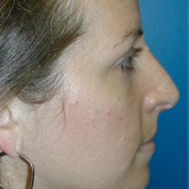B&A - Before
