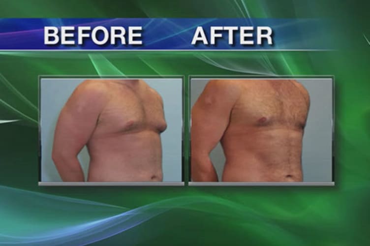 Photo of before and after male breast reduction featured on Think Health show
