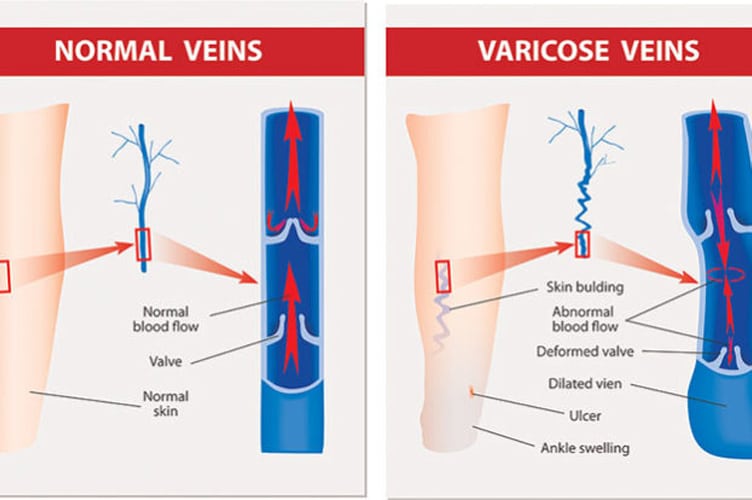 Comparison photo of normal veins vs varicose veins