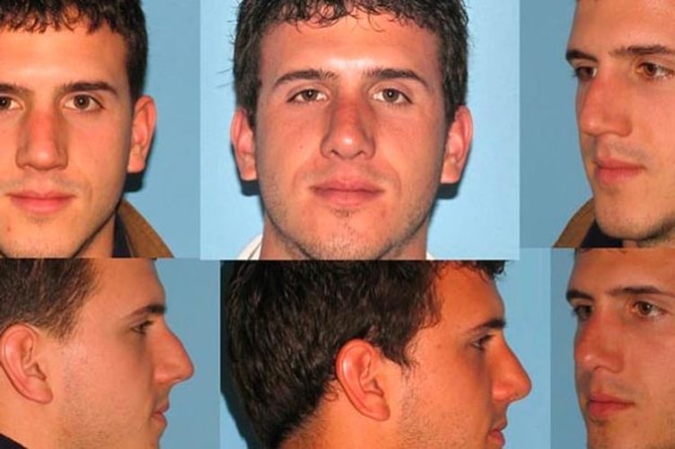 6 photos of different angles of the same man featuring the before and after of a rhinoplasty