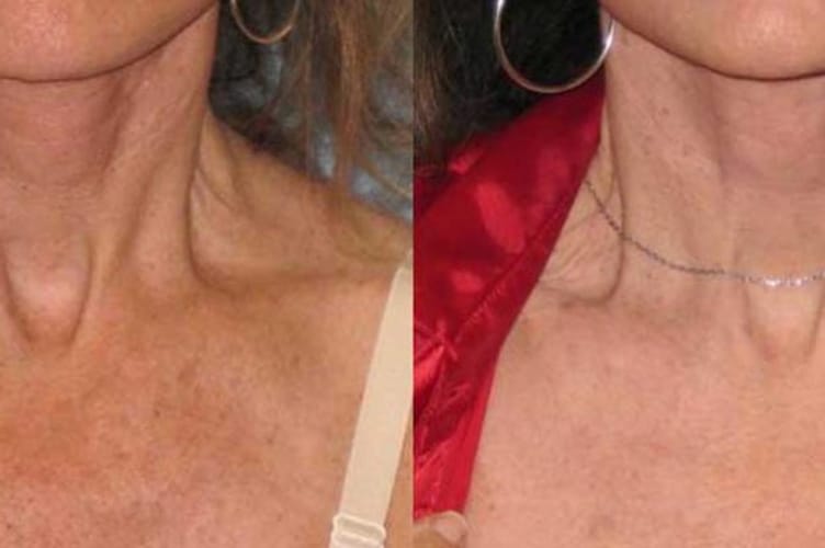 Photo of Neck lift Without Face Lift? for blog photo