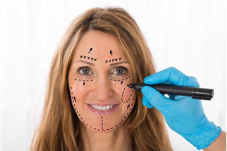 Woman smiling at the camera with surgical markings on her face, doctor drawing more marks on her face