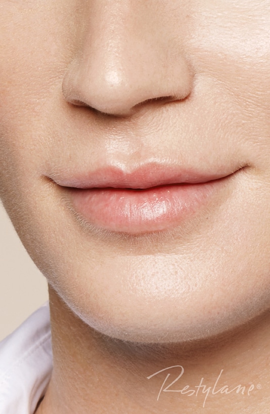 photo of Close up of a person's mouth smiling with lips closed for Restylane blog photo
