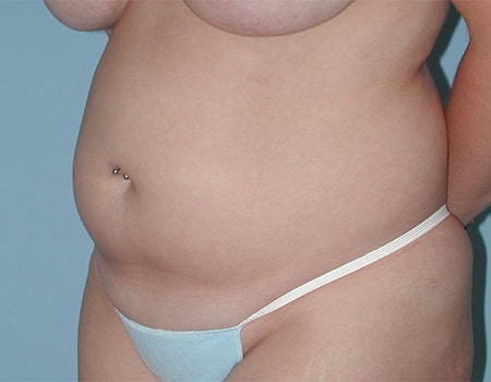Patient before Abdomen Liposuction procedure performed by Dr. Paul Vanek