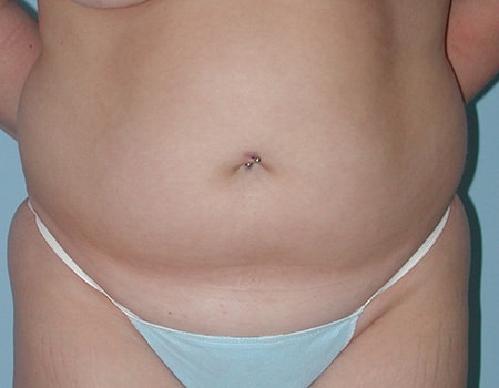 Patient before Abdomen Liposuction procedure performed by Dr. Paul Vanek