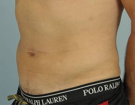 Patient after Abdomen Liposuction procedure performed by Dr. Paul Vanek