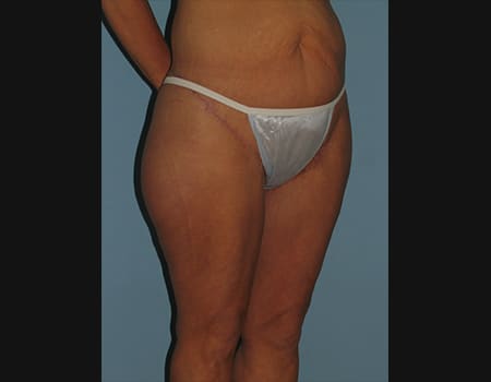 Patient after Thigh procedure performed by Dr. Paul Vanek