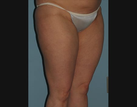 Patient after Thigh procedure performed by Dr. Paul Vanek