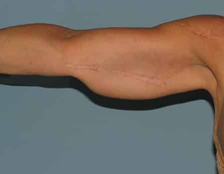 Female patient after Arm Liposuction procedure performed by Dr. Paul Vanek