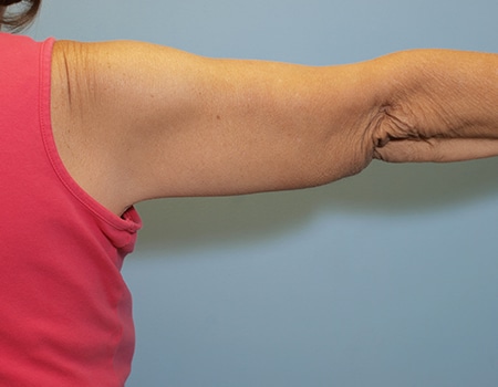 Female patient after Arm Liposuction procedure performed by Dr. Paul Vanek