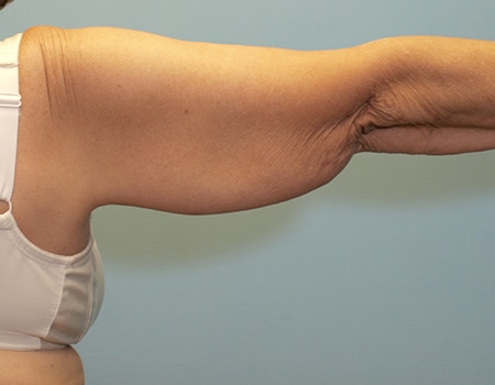 Female patient before Arm Liposuction procedure performed by Dr. Paul Vanek