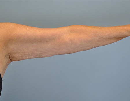 Female patient before Arm Liposuction procedure performed by Dr. Paul Vanek