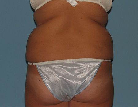 Patient before Back and Flanks Liposuction procedure performed by Dr. Paul Vanek