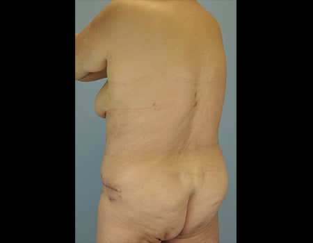 Patient after Back and Flanks Liposuction procedure performed by Dr. Paul Vanek