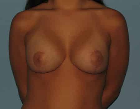 Female patient after Breast Asymmetry procedure performed by Dr. Paul Vanek
