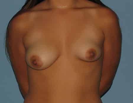 Female patient before Breast Asymmetry procedure performed by Dr. Paul Vanek