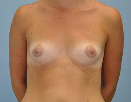 Female patient before Breast Augmentation procedure performed by Dr. Paul Vanek