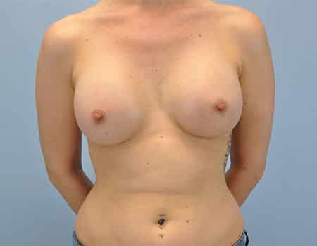 Female patient after Breast Augmentation procedure performed by Dr. Paul Vanek
