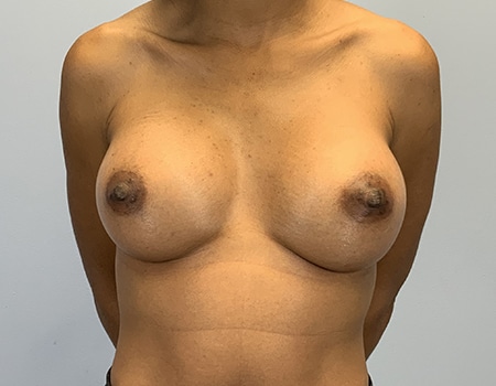Female patient after Breast Augmentation procedure performed by Dr. Paul Vanek