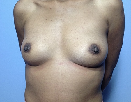 Female patient before Breast Augmentation procedure performed by Dr. Paul Vanek