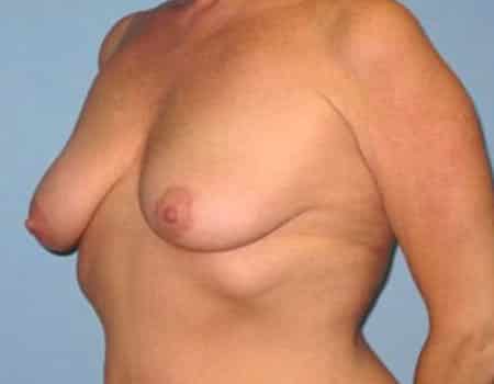 Female patient before Breast Lift procedure performed by Dr. Paul Vanek