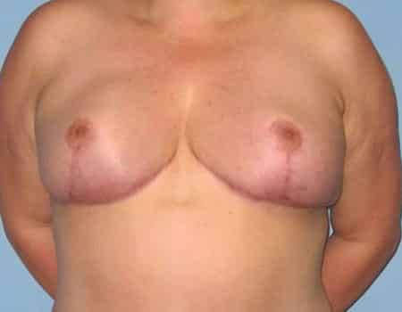 Patient after Breast Reduction procedure performed by Dr. Paul Vanek