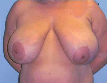 Patient before Breast Reduction procedure performed by Dr. Paul Vanek