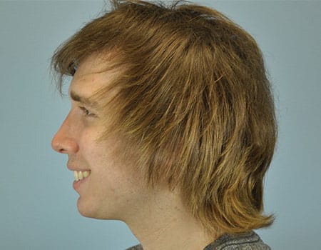 Male patient after Chin Augmentation procedure performed by Dr. Paul Vanek