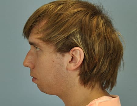 Male patient before Chin Augmentation procedure performed by Dr. Paul Vanek