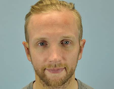 Male patient after Ear Surgery procedure performed by Dr. Paul Vanek
