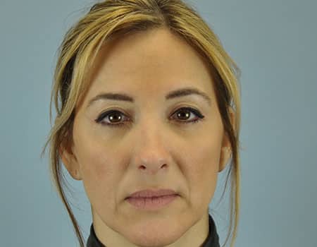 Female patient after eyelid surgery, performed by Dr. Paul Vanek