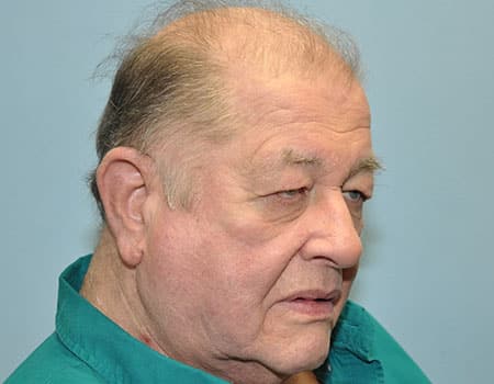 Male patient before Eyelid Surgery performed by Dr. Paul Vanek