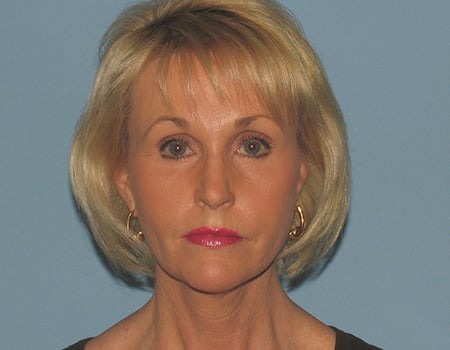 Blonde woman after facelift looking at the camera