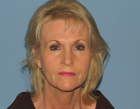 Blonde woman before facelift looking at the camera