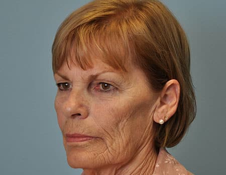 Female before Facial Fat Transfer procedure performed by Dr. Paul Vanek