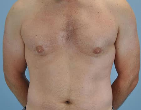 Patient after Gynecomastia procedure performed by Dr. Paul Vanek