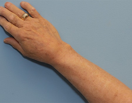 Patient's arm after Laser Skin Rejuvination procedure performed by Dr. Paul Vanek