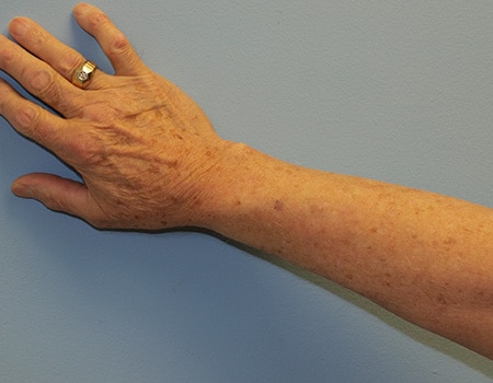 Patient's arm before Laser Skin Rejuvination procedure performed by Dr. Paul Vanek