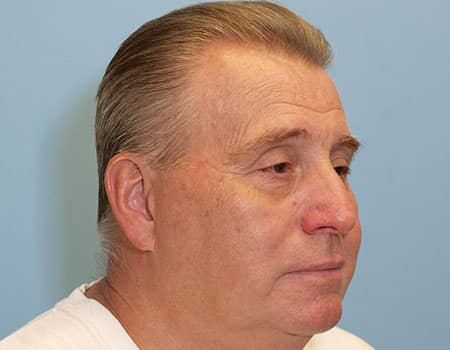 Patient after Laser Skin Rejuvination procedure performed by Dr. Paul Vanek