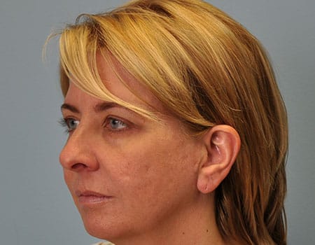 Female patient before Lip Augmentation procedure performed by Dr. Paul Vanek