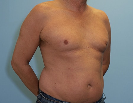 Patient before Men's Body Contouring procedure performed by Dr. Paul Vanek