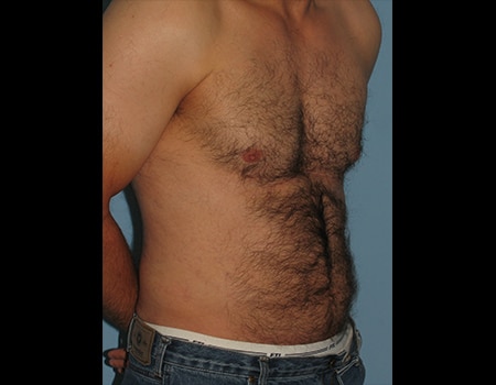 Patient after Men's Body Contouring procedure performed by Dr. Paul Vanek