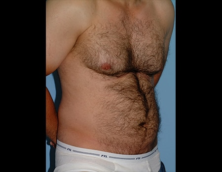 Patient before Men's Body Contouring procedure performed by Dr. Paul Vanek