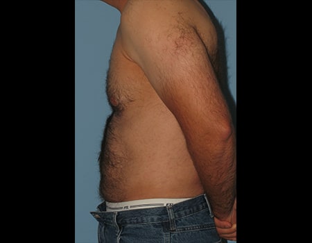 Patient after Men's Body Contouring procedure performed by Dr. Paul Vanek