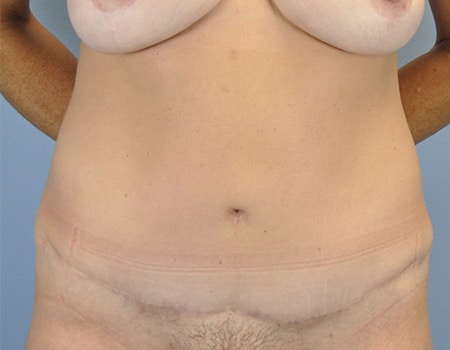Patient after Mommy Makeover procedure performed by Dr. Paul Vanek