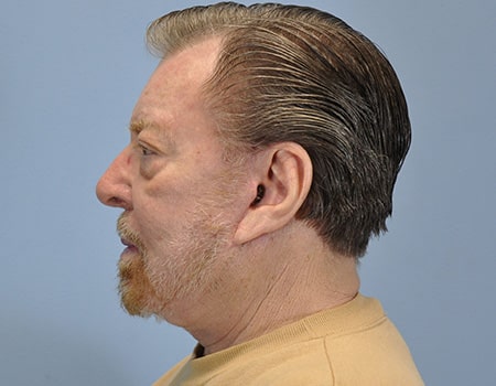 Male patient after neck lift procedure performed by Dr. Paul Vanek