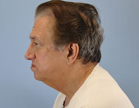 Male patient before neck lift procedure performed by Dr. Paul Vanek