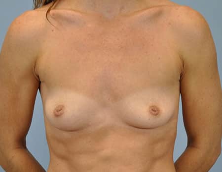 Female patient before nipple procedure performed by Dr. Paul Vanek