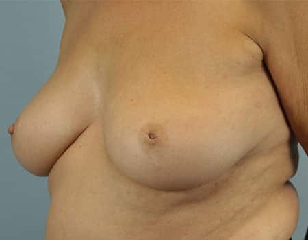 Female patient before Breast Lift procedure performed by Dr. Paul Vanek
